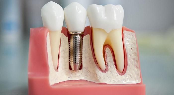 Что делать, когда нужно вставить зуб: какой вариант выбрать