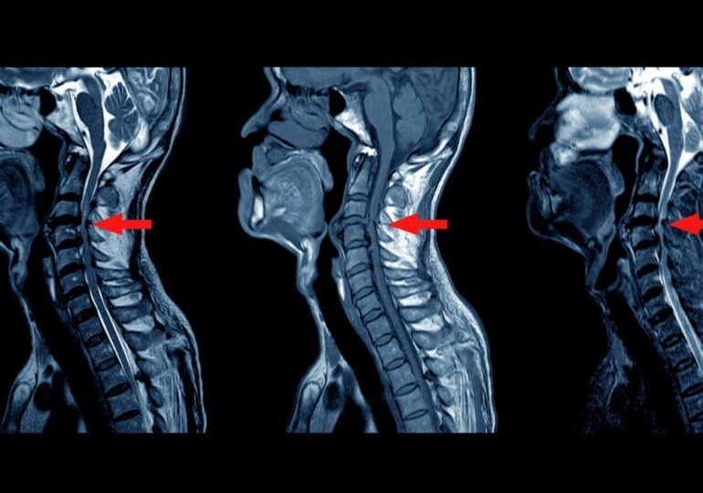 Магнітно-резонансна томографія (МРТ) шиї: коли та кому потрібна