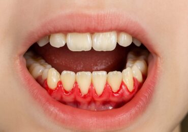 Де пройти професійну діагностику та лікування пародонтиту у Києві?